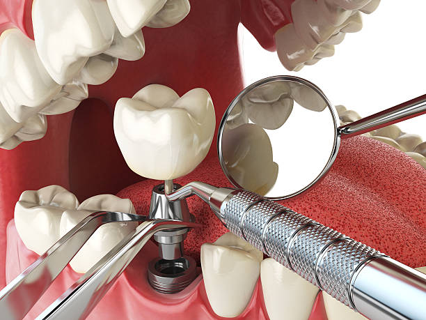 Best Emergency Wisdom Tooth Extraction in Colfax, CA